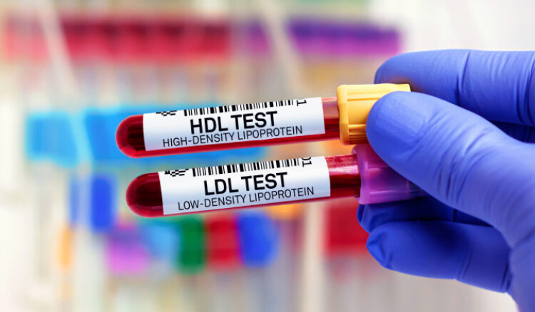 Nomi colesterolo hdl ldl vldl